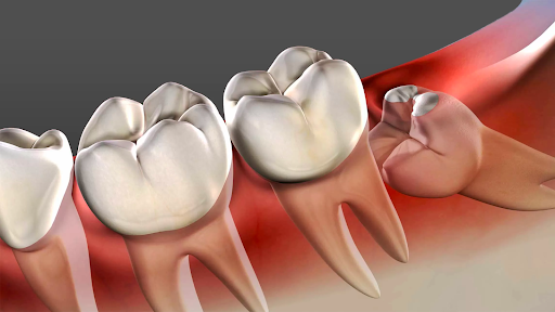 Tooth Corner's Wisdom Tooth Extraction Services in Waterloo