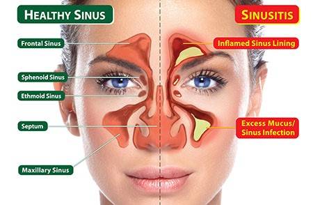 chronic sinusitis treatment